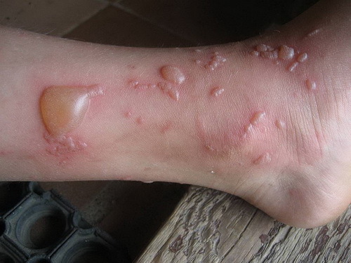 Fitofotodermaditis-a növény nedve által okozott égési sérülés